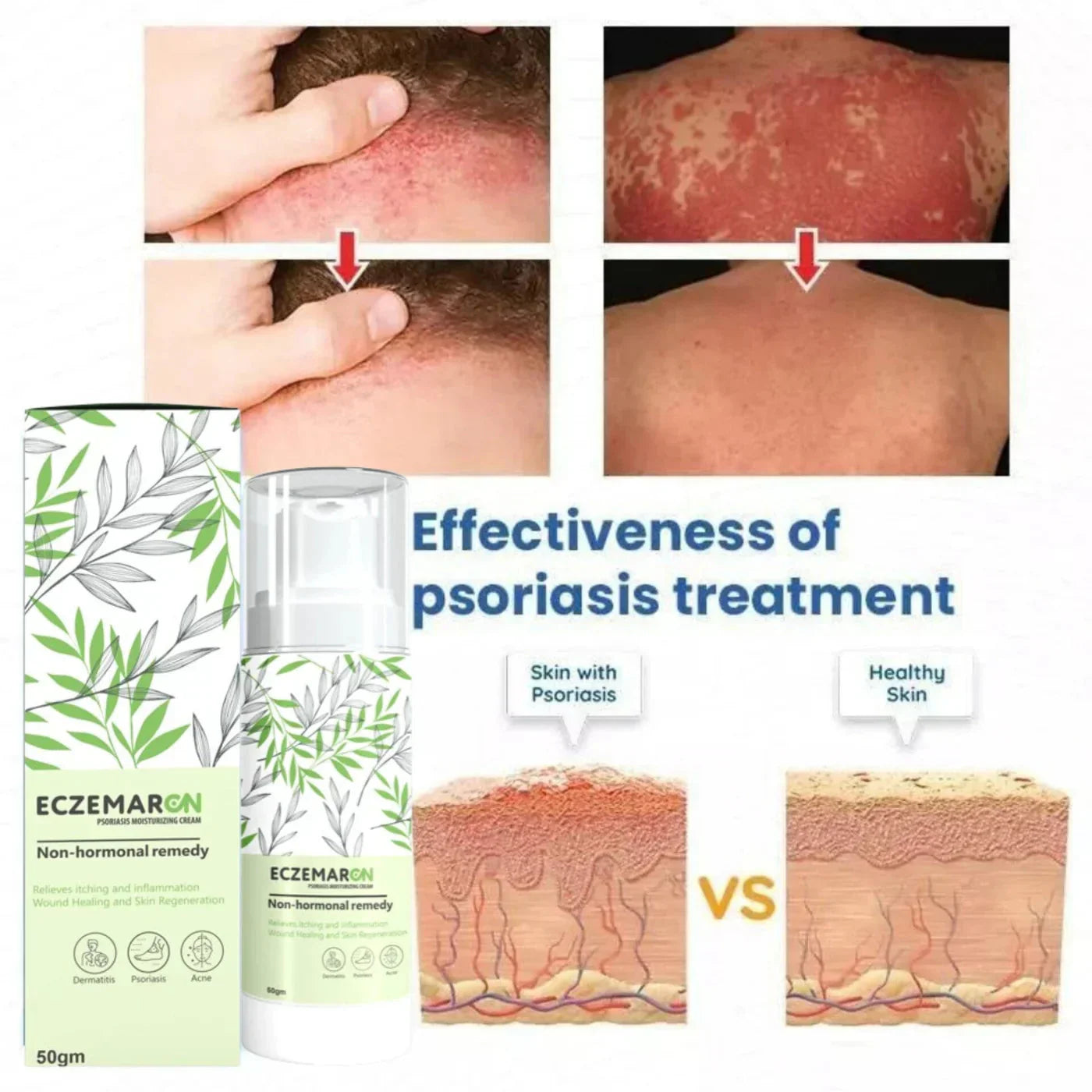 Eczemaron Anti Fungal Cream with Free Pain Relief Spray | Buy 1 Get 1 Free